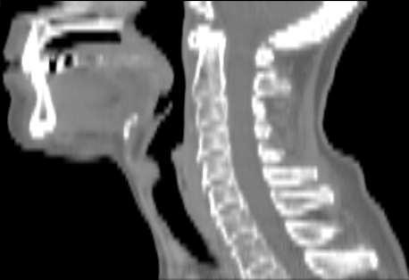 Spiral-CT Fördelar - Överlappande bildrekonstruktion med tunna snitt