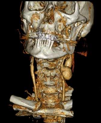 malignitetsutredning - CT angiografi ersätter carotis- eller