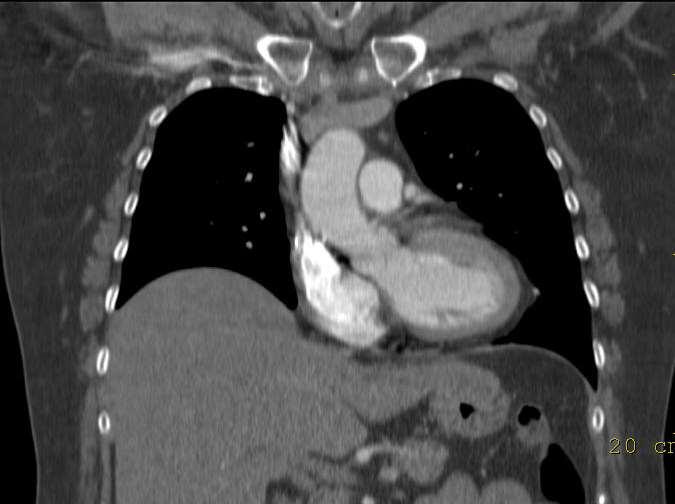 CT Thorax - Standardmetod för alla