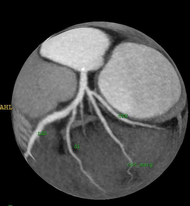 Cardiac CT