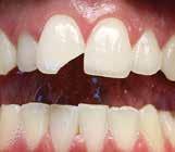 Permanenta tänder En olycka händer så lätt. Skadan kan drabba tanden, käkbenet, slemhinnan och huden. Kontakta tandvården för råd.