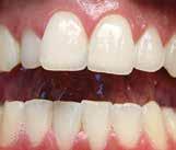 Om roten inte är färdigutvecklad har tanden bättre möjlighet att klara av en skada än om rotutvecklingen är avslutad. En skada på en permanent tand ska alltid undersökas av tandläkare.