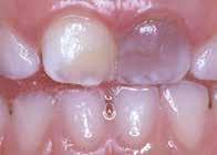 Slagit av en bit av tanden Det kan göra ont och isa i tanden när barnet tuggar.