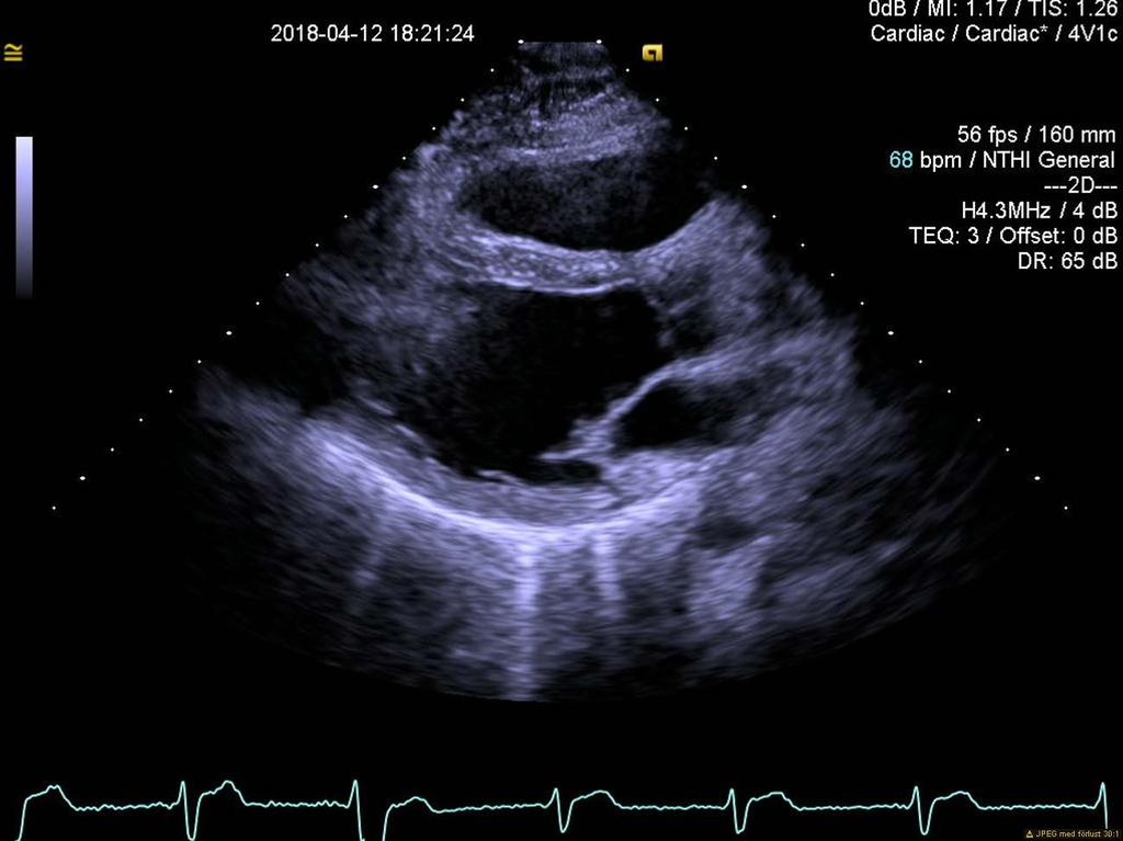 Figur 1: Ultraljudsbild av hjärta i parasternal långaxel Klaffvitier Andra mått som kan tas i parasternal långaxel förutom diametern är kammarseptums tjocklek och bakväggstjockleken (1, 2, 5).