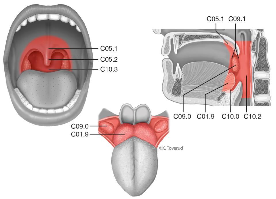 14.9 Orofarynxcancer 14.9.1 Översikt ICD-10 Tonsill C09.0, C09.8, C09.9 Tungbas C01.9 Gombåge C09.1 Mjuka gommens yta mot munhåla C05.1, C05.8, C05.