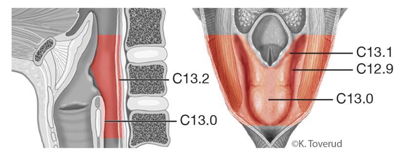 14.11 Hypofarynxcancer 14.11.1 Översikt ICD-10 Sinus piriformis C12.9 Postkrikoidala rummet C13.0 Aryepiglottiska vecket, hypofaryngeala delen C13.1 Bakre hypofarynxväggen C13.2 Övergripande växt C13.