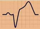 FAKTA 1. EKG-kriterier vid bedömning av misstänkt akut hjärtinfarkt och vänstergrenblock. ST-höjning 1 mm och konkordans med QRS-komplexet.