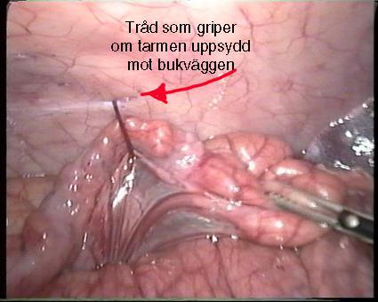 Grismodellen för LGBP med upphängd tarmslynga?