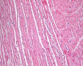 Myokardiets respons vid skadliga stimuli Hjärtmuskelvävnaden kan utsättas för olika former av skadliga stimuli, såsom ökad volymbelastning, ökad tryckbelastning, toxiner, inflammation, näringsbrist,