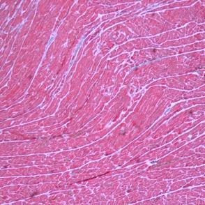 De morfologiska lesionerna som inkluderades i denna studie var: fibros, fettinfiltration samt intramural arterioskleros.