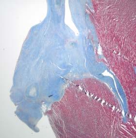 Fibroblasternas form varierade från spolformade, avlånga celler till mer avrundade, chondrocytliknande.
