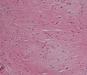 Katt nr 17, fokal endomyokardiell ersättningsfibros i vänster kammare. Hematoxylin-eosin-färgning, förstoring x1. Figur 21.