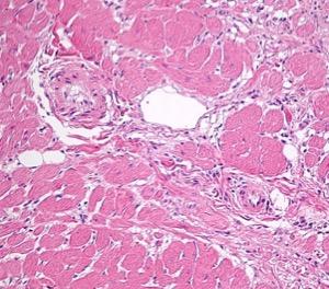 Figur 29. Arteriosklerotiska kärl.