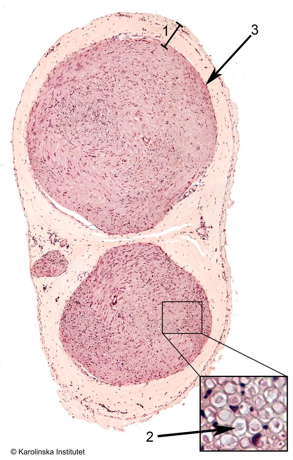 31:2. Perifer nerv, tvärsnitt Htx-eosin 1. Epineurium 3. Perineurium 2. Axon Preparatet består av ett tvärsnitt av en perifer nerv, inbäddad i en lucker bindväv innehållande mycket fettceller.