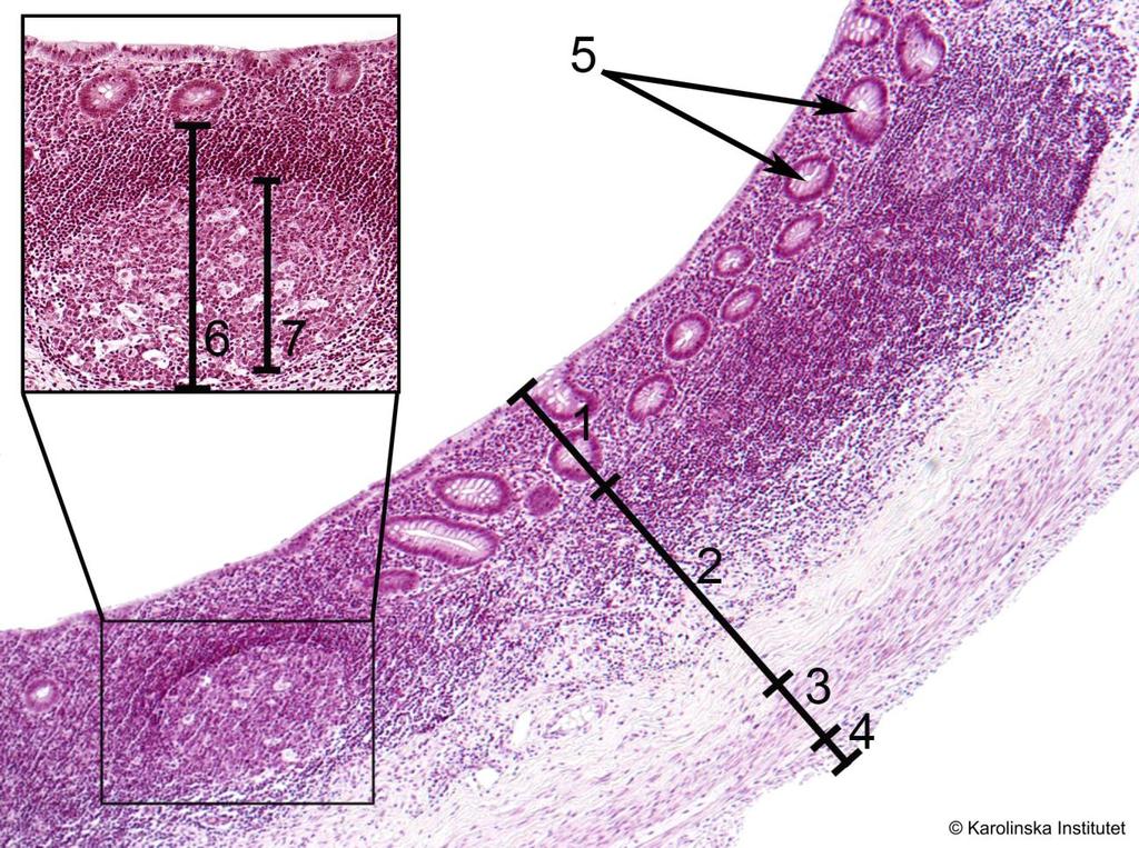 62. Appendix vermiformis Htx-eosin 1. Tunica mucosae 5. Lieberkühns körtlar 2. Tela submucosa 6. Lymfatisk follikel 3. Lamina muscularia externa 7. Groddcentra 4.