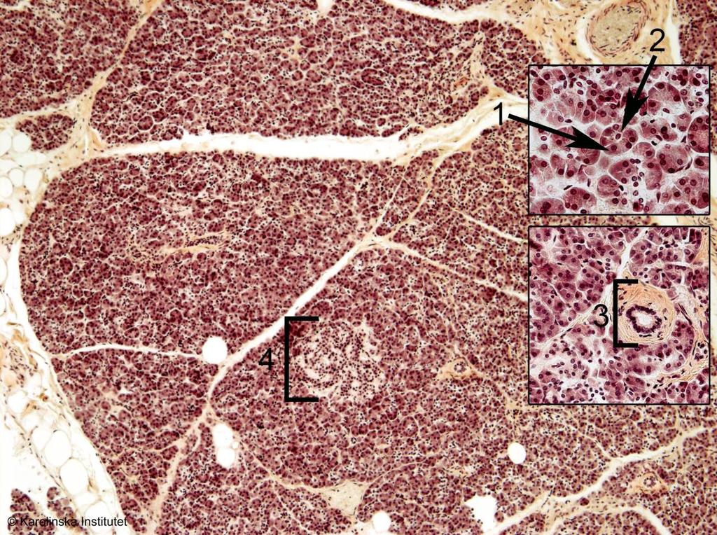 A73. Pancreas Htx-eosin 1. Acinär cell 3. Intralobulär utförsgång 2. Centroacinär cell 4. Langerhansk cellö I översiktsförstoring ser man kompakt, loberad körtelvävnad omgiven av bindväv.