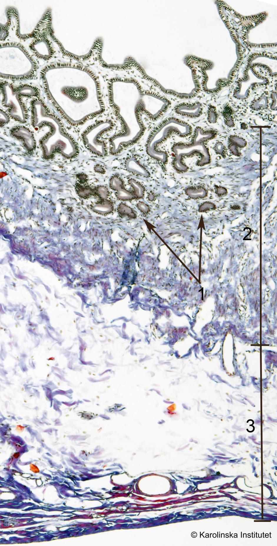 Vesica biliaris 1. Rokitansky-Aschoffsinus 2. Tunica muscularis 3. Tunica serosa I ena kanten av preparatet ses en ihålig struktur med mycket oregelbunden inre begränsning. Det är gallblåsan.