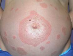 plaques of pregnancy/polymorphic eruption of pregnancy) Prurigo gestationis PFP