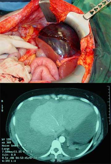 inr, apt, haptoglobin, antitrombin,