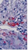 Transaminas- + bilirubin-stegring 100% Leukocytos (95%) Hypoglucemi (80%) 50% koagulopati utan