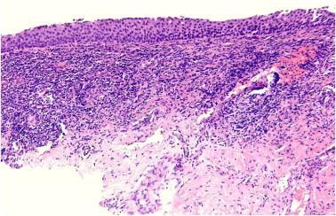 Erosiv lichen planus Diagnostik: histologi Stans från vitaktiga stråk / utanför erosionen (ospecifikt resultat om stans från erosion) -------------------- Prognos: fluktuationer, men