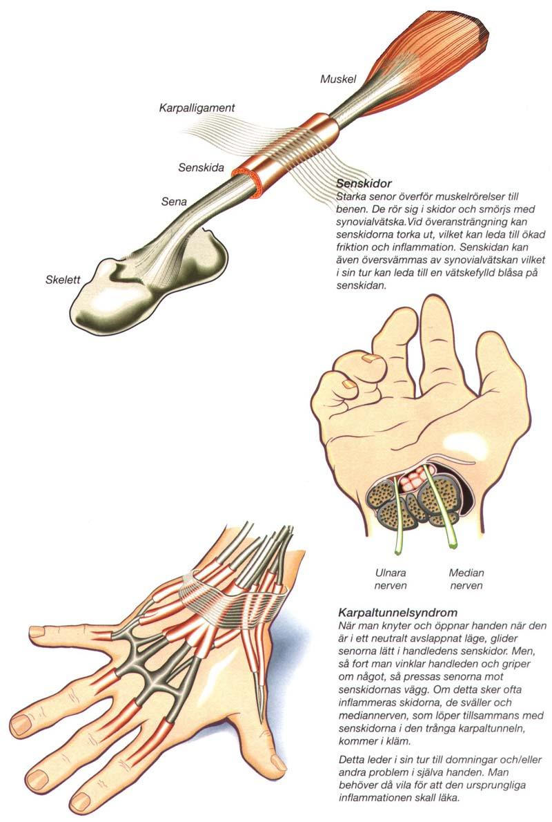 Arbetsrelaterade sjukdomar Belastningsskador leder till en mängd olika sjukdomar som karpaltunnelsyndrom, epikondylit ( tennisarmbåge), seninflammation, Myolgi (muskelsmärtor) och inflammation i