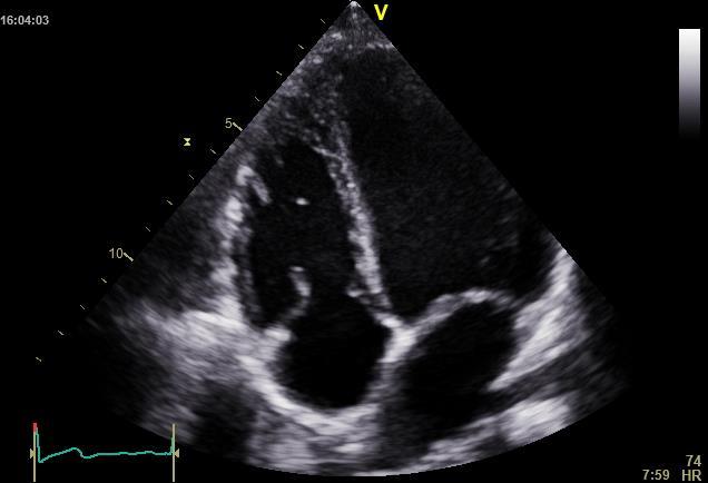 B: PLAX: höger kammares utflödesdiameter, RVOT1.