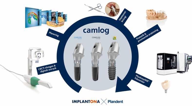 plandent implantat Digitalt arbetsflöde för din implantatbehandling Med ett digitalt arbetsflöde får du en standardiserad arbetsprocess som både är kostnadseffektiv och ger ett snabbare och exaktare