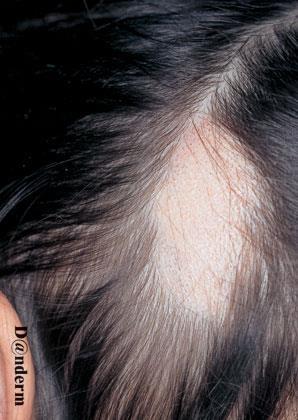 Alopecia