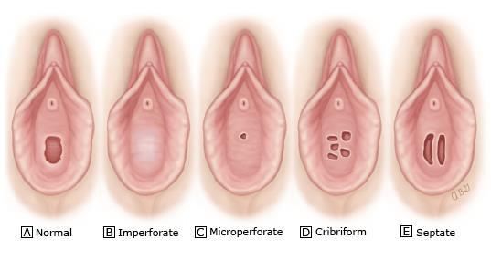 septa: longitudinellt i vagina vid