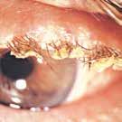 Mucinlager Mucin (slem) produceras av bägarcellerna som finns i konjunktiva (slemhinna som täcker ögat och ögonlockets insida).