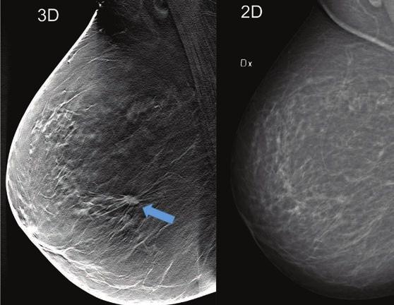 Primära utfallsmått i Malmö Breast Tomosynthesis Screening Trial (95% konfidensintervall) Granskningsarm DBT Granskningsarm DM P-värde Sensitivitet (%)** 81 1 (74 2 86 9) DBT 60 4 (52 3 68 0)