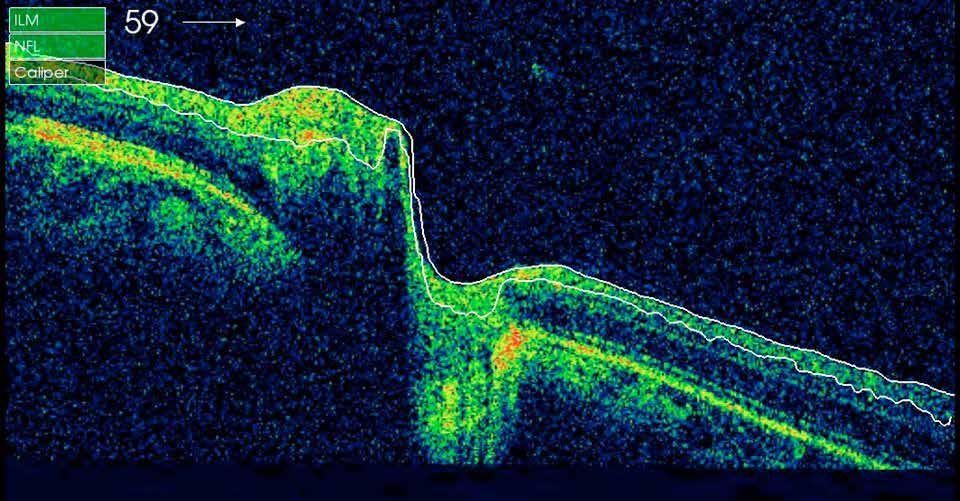 OCT Optical Coherence TOMOGRAPHY En modern metod för att