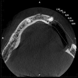 DATORTOMOGRAFIUNDERSÖKNING PROMAX 3D INFÖR