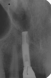 23 apikalt vidgad periodontalspalt.