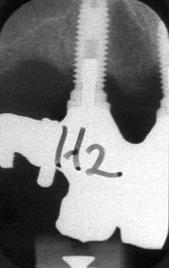 implantat