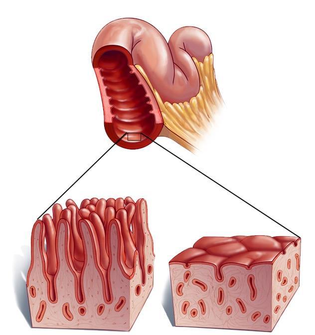 Glutenintolerans, tarmpåverkan Gluten skadar tarmen, även små mängder Ytan minskar och näringsupptaget minskar Möjliga symptom: