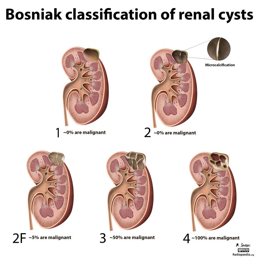 REGIONALA CANCERCENTRUM Bosniak III-cystor [23] behandlas med kirurgi alternativt uppföljning, förslagsvis efter 1 år, 3 år och 5