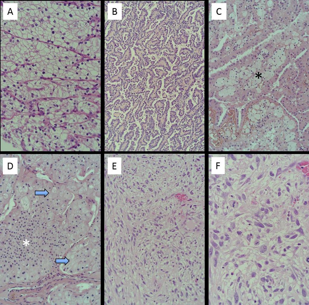 REGIONALA CANCERCENTRUM Figur 8. Histologiskt utseende hos de vanligaste njurcancerformerna A. Klarcellig njurcancer med karaktäristiskt "tom" cytoplasma och uttalad kärl/kapillärtäthet. B.