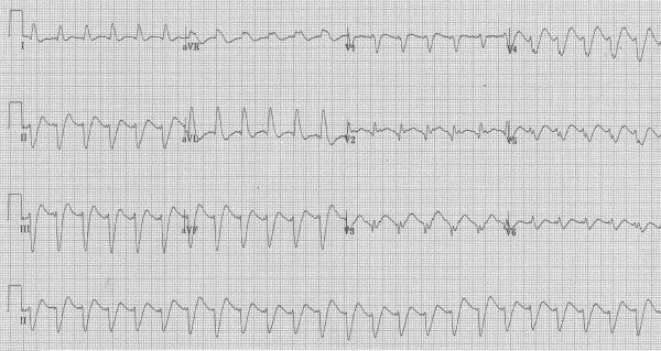Case report: Successful lipid resuscitation in multidrug
