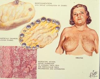 PCOS 1935 Stein-Leventhals syndrom: anovulation, hirsutism, fetma, infertilitet och polycystiska