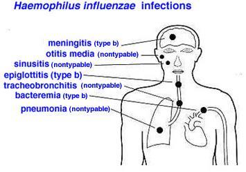 Haemophilus influenzae typ b H.