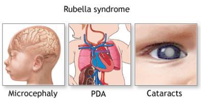 Rubellavirus, röda hund Togavirus Aerosol droppsmitta - slh, inkubation 14-21 dagar, smittsam 1 v