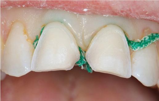 max Ceram Lava Ceram IPS Empress CAD IPS Empress Esthetic Hass Rosetta BM IPS e.max CAD IPS e.