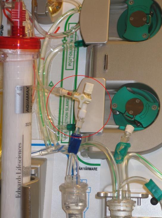 HEPARIN PROTAMIN PROTAMIN Heparin och Protamin tillförs patienten enligt gällande rutin för avdelningen. Se PM Rekommenderade inställningar.