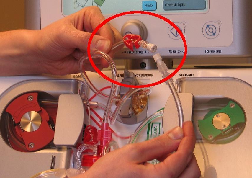 1. Stäng klämman på predilutionsslangen, för att på så sätt minimera risken för blodläckage till slangen. Försäkra dig om att slangen är fri från blod.