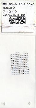 Figure 3. A tissue microarray glass slide with magnifications of an immunohistochemically stained tissue core representing a malignant melanoma.