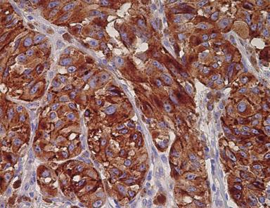 evaluation of potential biomarkers. One major concern with the use of TMAs is that 0.6-1 mm small samples might not be representative for the entire tumor.