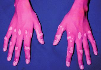 Vitiligo vulgaris Generalized vitiligo (vitiligo vulgaris) is an acquired cutaneous disorder, characterized by a localized and progressive loss of skin pigmentation.