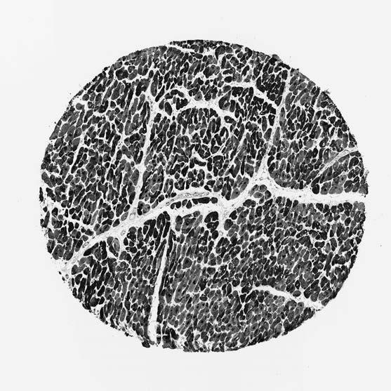 skattkarta eller atlas? Figur 1. Hjärtmuskulatur på patient 2523 infärgad med antikropp HP A006028 i Human Protein Atlas. Bildkälla: http://www.proteinatlas. org/images/6028/18417_b_5_6.jpg.